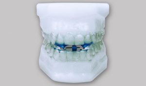 Tratamiento de los ronquidos y apneas de sueño clinica dental en Burgos