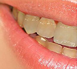 Sin Tratamiento Blanquear Dientes en la Clínica Dental Raquel Gómez en Burgos